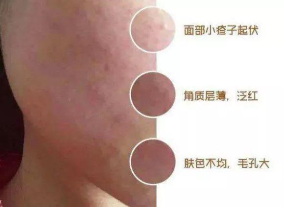 聚焦315，坑钱又毁容的劣质护肤品，教你5招轻松鉴别