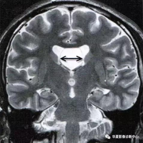 透明隔腔与透明囊肿鉴别,透明隔间腔与囊肿区别