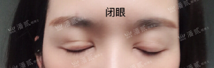 10个工作室做，9个毁，祛眼袋连卧蚕也没了，直接送我到10年后