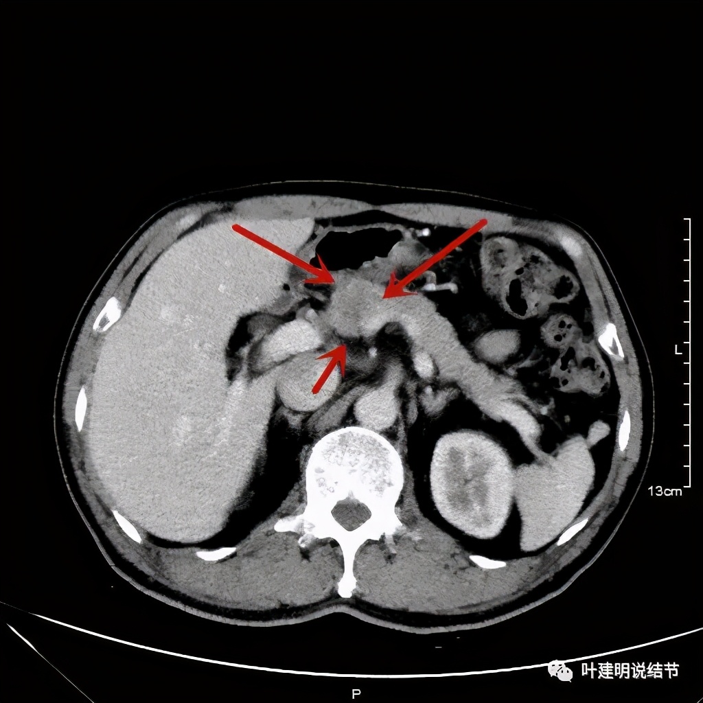 实性结节影要不要紧,实性结节穿刺活检为良性
