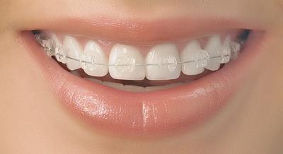 吴宣仪烤瓷牙怎么做,吴宣仪的整牙前