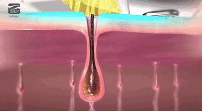 身体护理鸡皮肤,身体保湿大作战