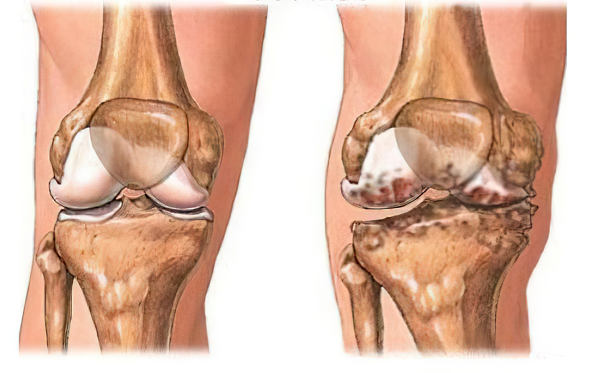 膝关节骨软骨损伤什么原因,膝关节骨关节炎软骨退化康复训练