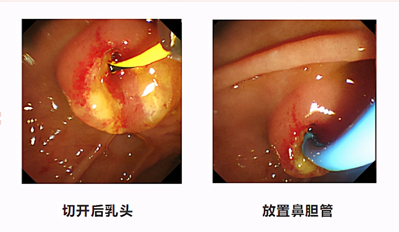 银川市胆管结石微创手术,华西医生内镜取胆管结石