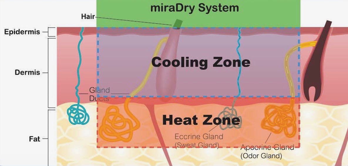 腋臭特效药一览表,miradry微波腋臭手术哪里可以做