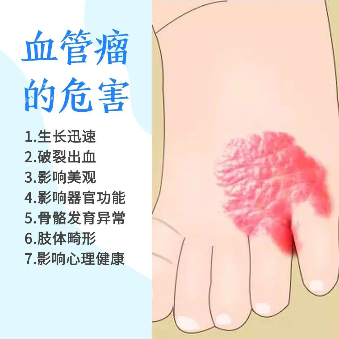 新生儿红胎记与血管瘤区别,红胎记血管瘤的最佳消除方法