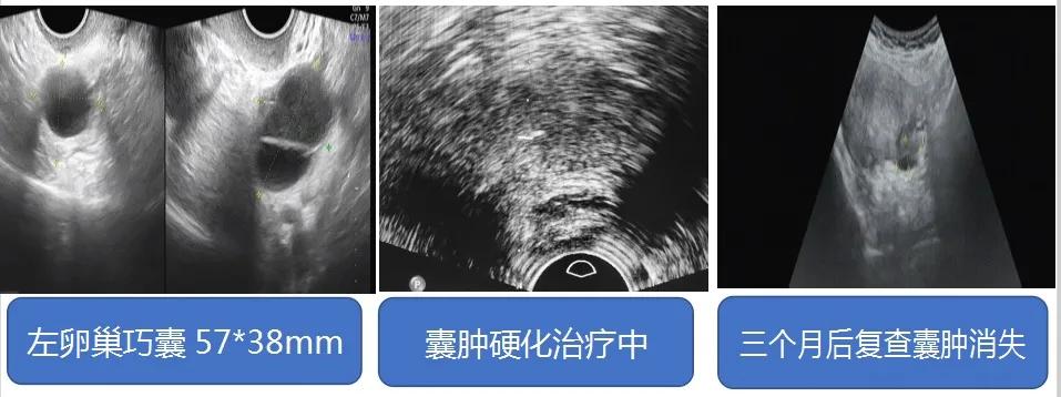 红兴隆中心医院,超声科囊肿治疗视频