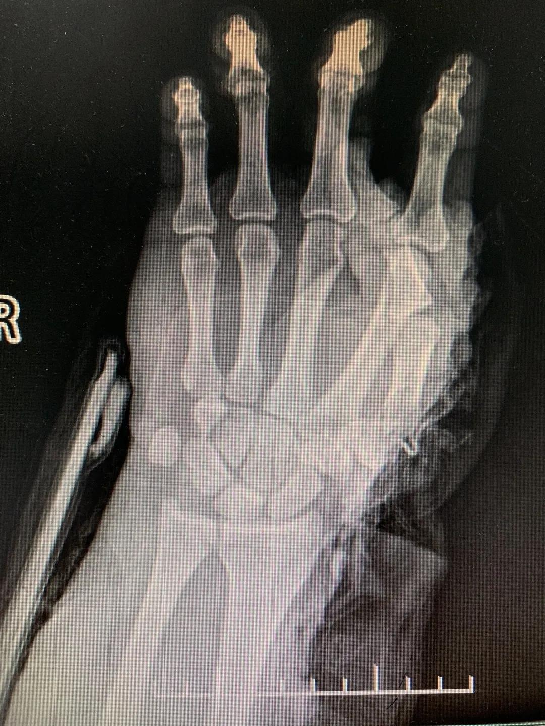 【日照市人民医院】右臂卷入机器被撕裂　6.5小时成功复活