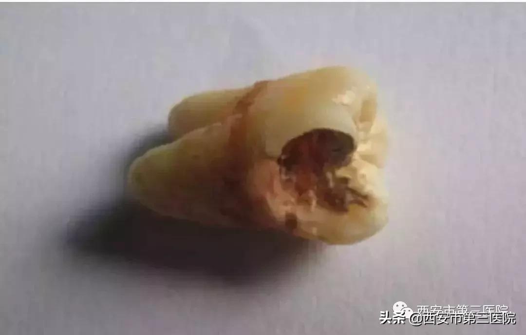 拔智齿不长平咋办,拔第二磨牙不拔智齿可以吗