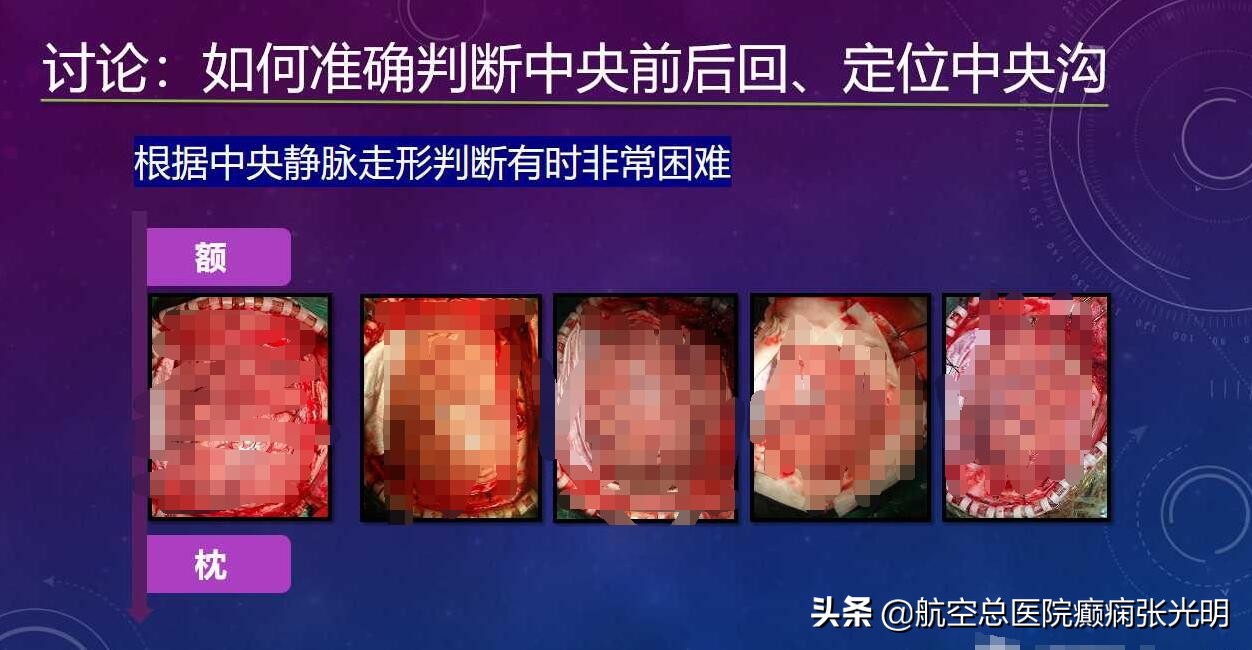 张光明左颞叶癫痫手术成功率,张光明谈治疗癫痫的方法有哪些