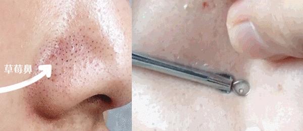 有黑头和没黑头有什么区别,没有长过黑头却长黑头怎么办