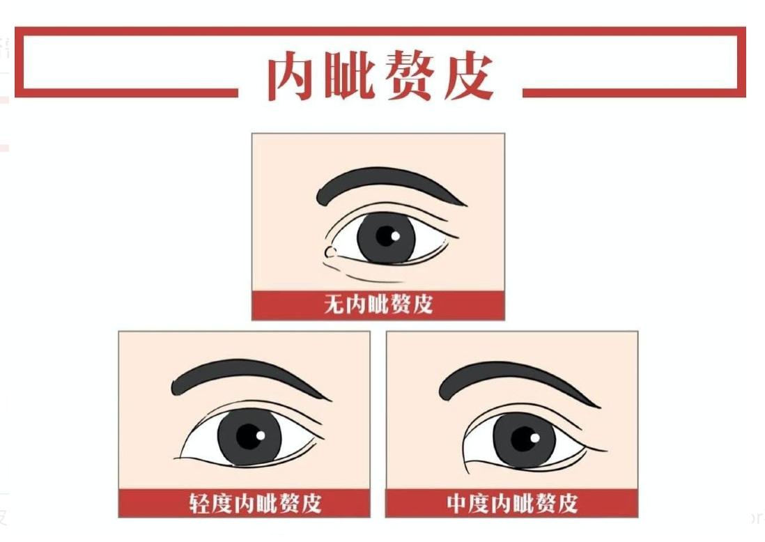 做双眼皮手术有风险呢,一般双眼皮手术价格表