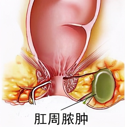 肛周脓肿治疗不及时可危及生命！关于它的知识，你了解多少？