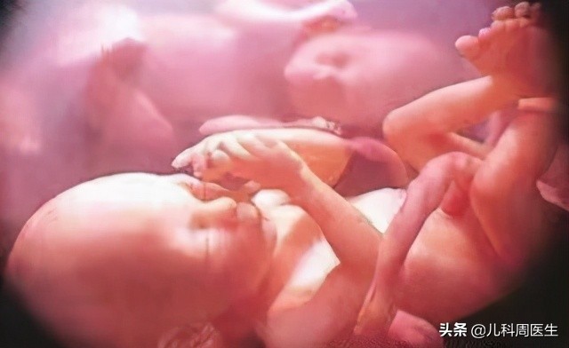 胎儿脐绕颈一周会自己绕回来吗,胎儿绕脐带3圈怎么办