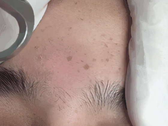 脸上有斑用什么护肤品祛斑效果好,40岁女人脸上长斑怎样有效祛斑