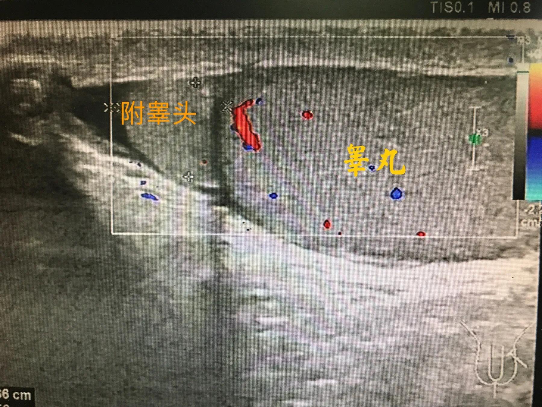 睾丸发生什么样的变化会影响生育,两侧睾丸都碎裂影响生育吗