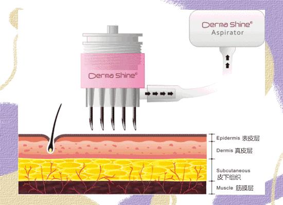 医美做什么能永远不长痘,脸很多痘坑做什么医美