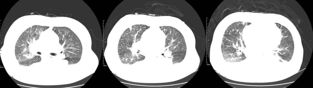 这例患者差点误诊为CAP，类似病变应如何逃离误诊「高发区」？