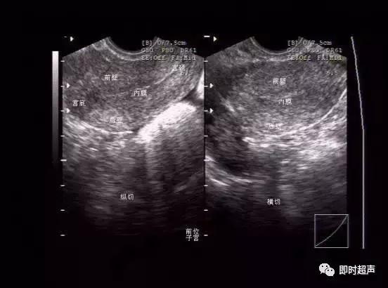 阴部超声检查什么时候做,妇科阴式超声检查方法