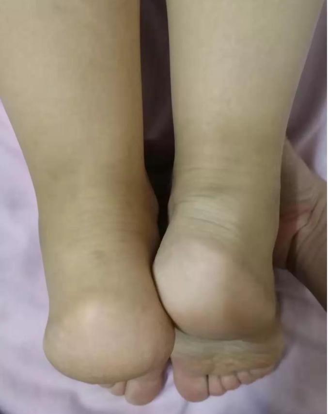 产后长短腿如何矫正,产后长短腿形成的原因和治疗方法