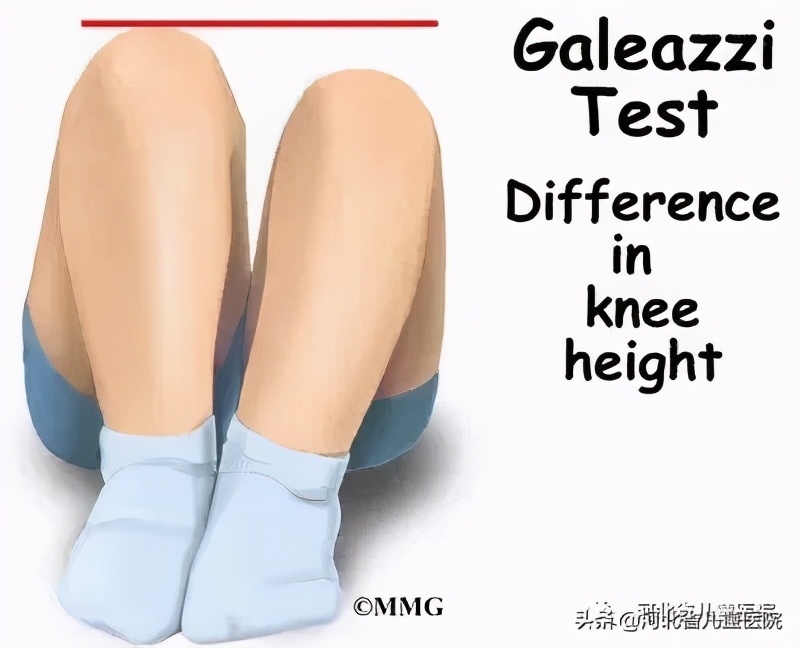 腿纹不对称家长千万别忽视,腿纹深浅不一样算不对称吗