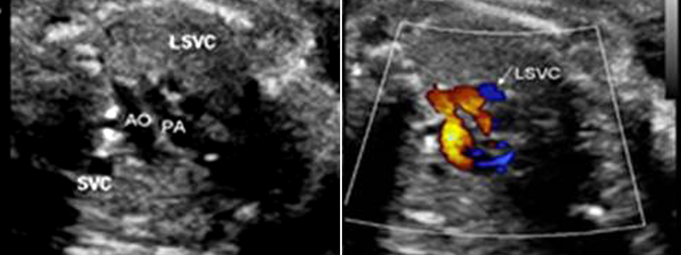 胎儿心脏发育异常微小室间隔缺损,胎儿心脏缺损1.3毫米严重吗