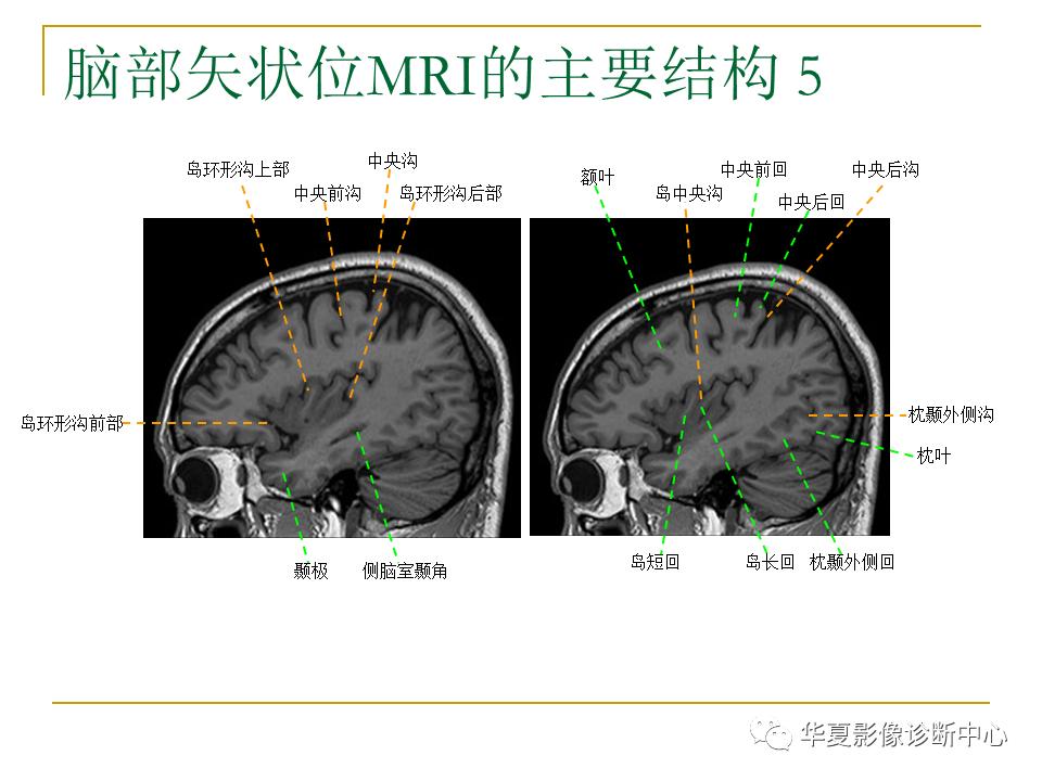 中国人脑立体定向mri应用解剖图谱,脑mri示意图