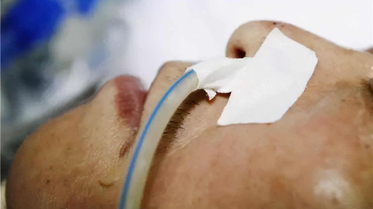 插胃管进食造成肺感染,胃管误入气管属于几级不良事件