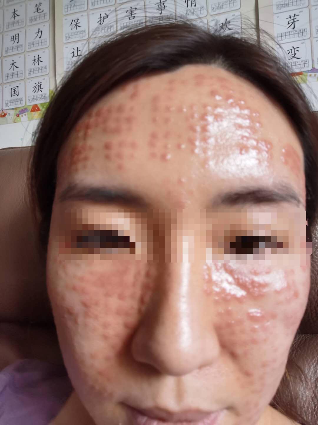 一次水光针相当于敷了1000次面膜,一次水光针等于10次补水