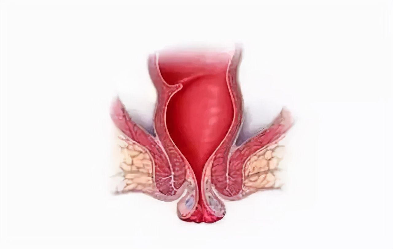 肛门总有撕裂感,肛门处条状物