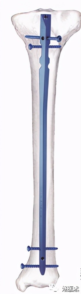 髓内钉技巧,髓内钉教学视频讲解