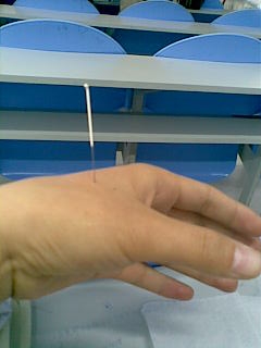 面神经麻痹针灸最佳穴位是,面神经麻痹的针灸治疗取穴有哪些