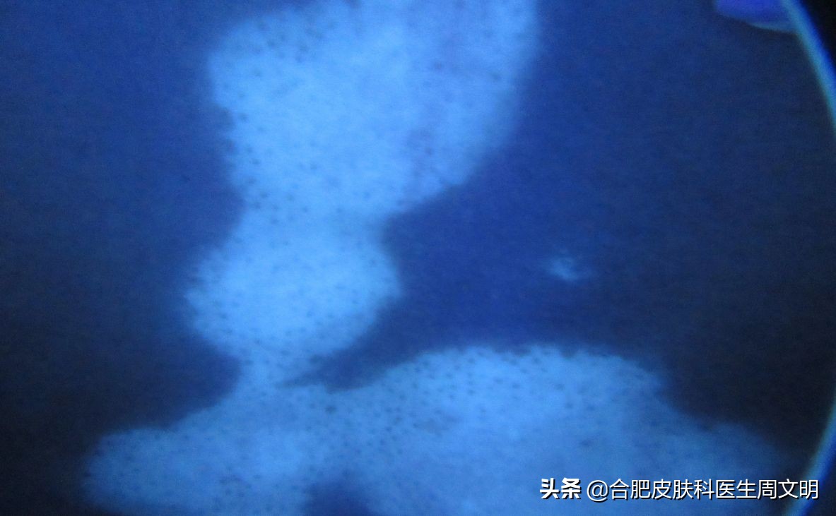 白癜风牛皮癣皮肤病为什么难治,白癜风治不好病情反复原因