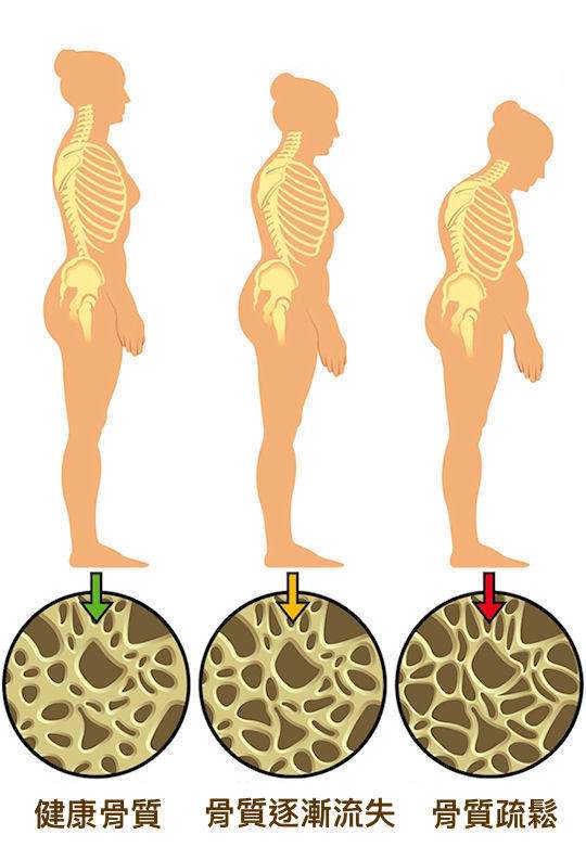 风湿需要补钙吗,风湿关节炎为什么要吃钙