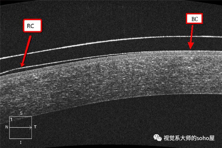 视光方面的知识,视光眼科科普