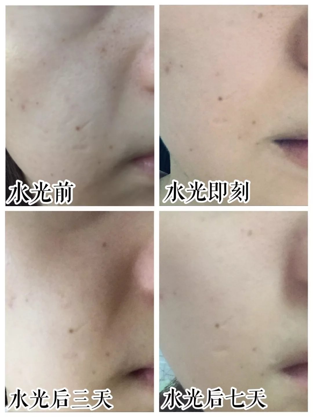 几百块和几千块的水光针，到底差在哪？