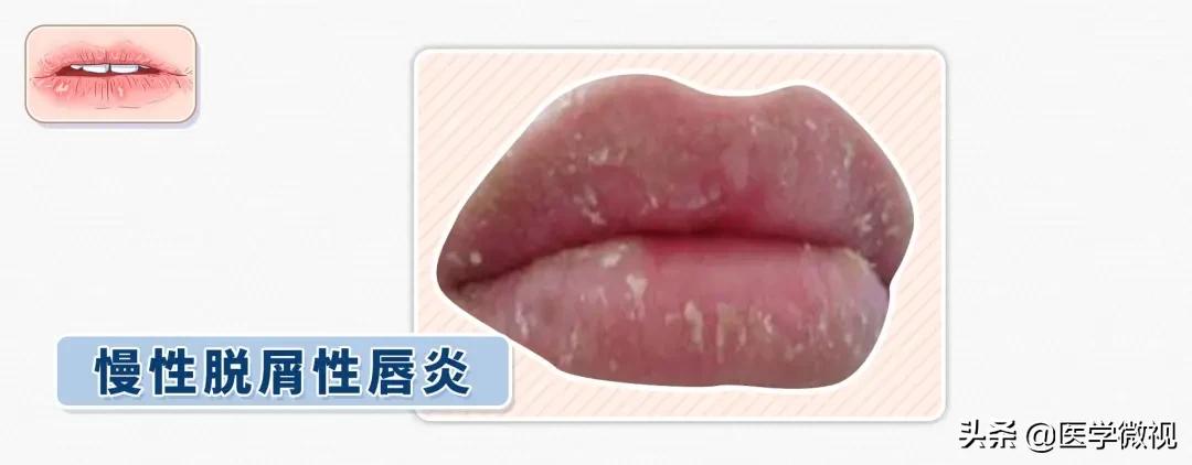 嘴唇干裂起皮反反复复,嘴唇一年四季干燥起皮是什么原因