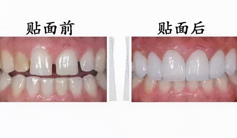 牙齿特别黄洗牙都没用怎么美白,什么牙膏美白牙齿去黄最好