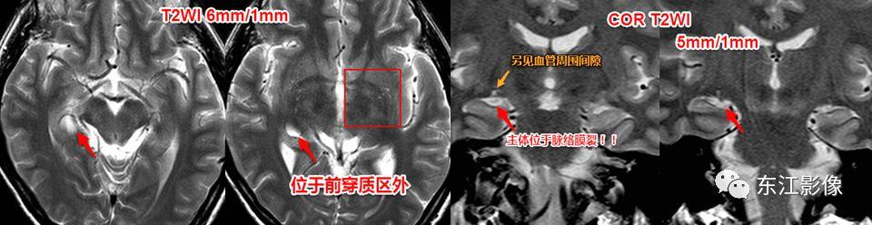头颅mri扫描影像哪里找,头颅影像mra详细解说