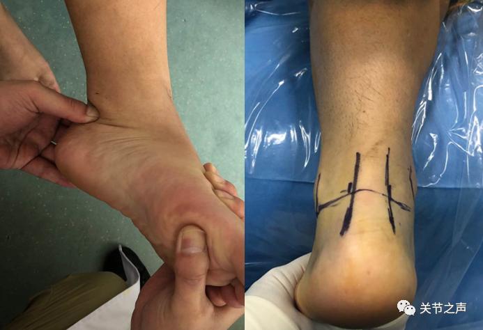 小伙打球崴脚过后检查跟腱断裂,小伙打球崴脚