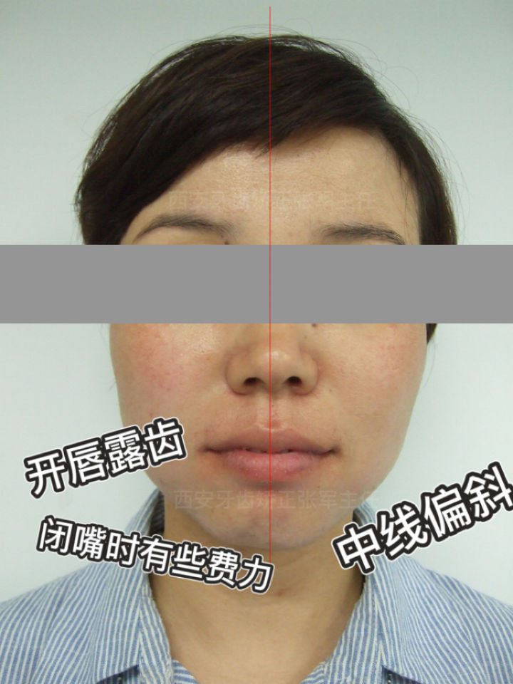 西安透明式牙齿矫正器龅牙,昆明牙齿矫正改变脸型