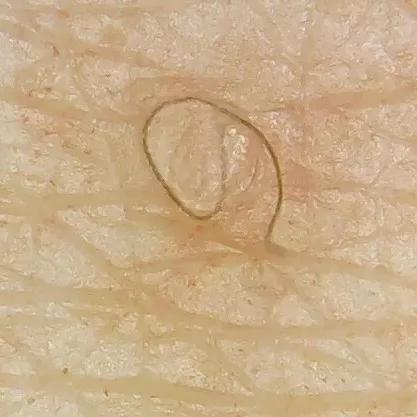 又到了穿小裙的季节，鸡皮女孩该怎么办……