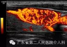 甲状腺良性腺瘤做消融好吗,甲状腺囊性腺瘤用做手术吗