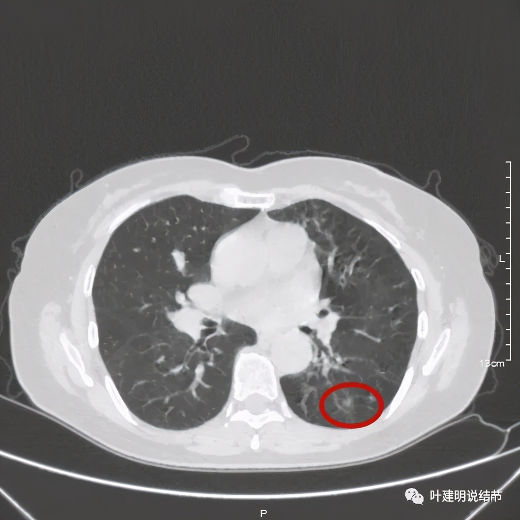 这样的实性结节伴小空洞会是肺癌吗？