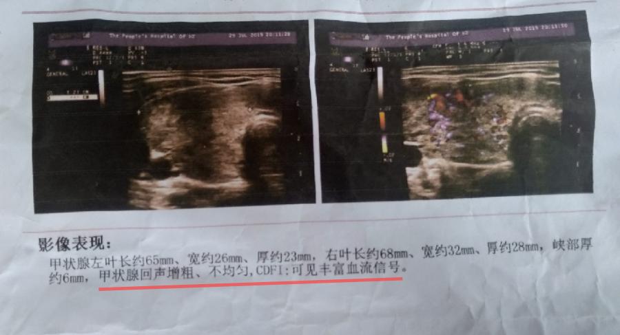 脖子肿吃药才消肿,吃了激素药会脖子发肿吗