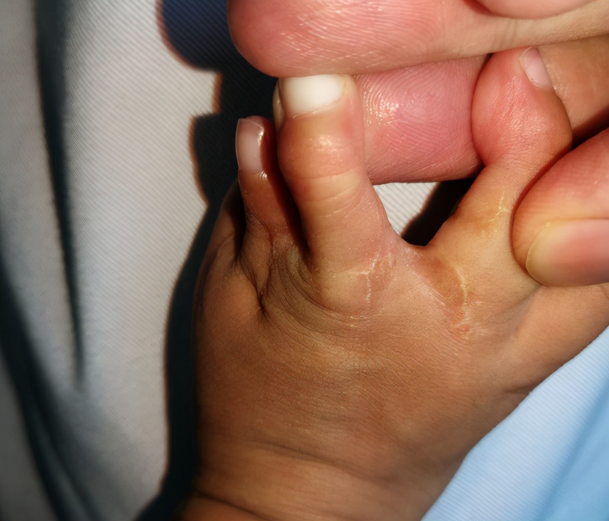 并指畸形免植皮案例,并指畸形