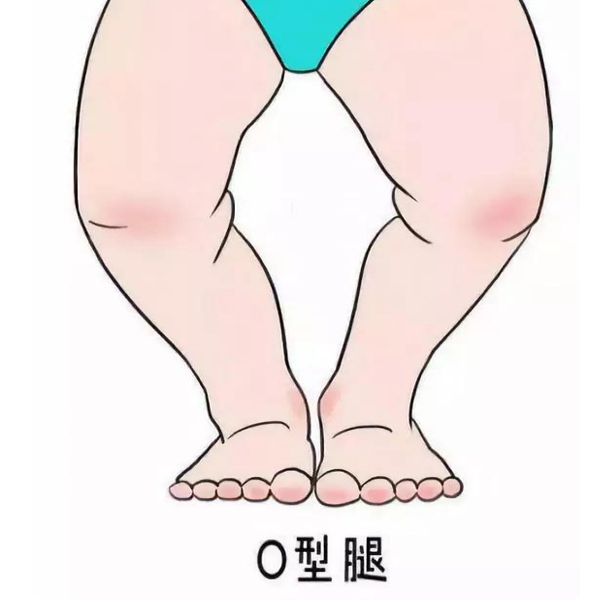 绑腿带对20岁矫正o型腿有用吗,1岁宝宝o型腿晚上睡觉绑腿有用吗