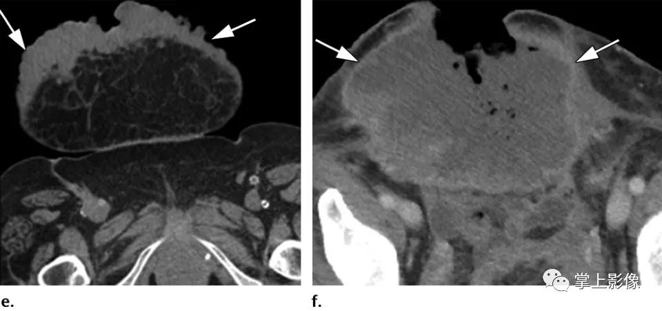 腹壁病变诊断思路,腹部影像诊断读片入门视频