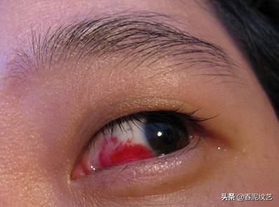 纹了美瞳线后眼睛肿怎么回事,摘完美瞳眼睛发红