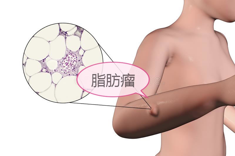 皮下脂肪瘤突然增大又会变小,长了脂肪瘤怎么办